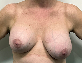 breast revision before